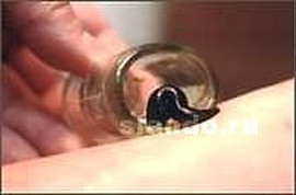 Гирудотерапия