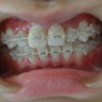 orthodontic brackets-ceramic bracket