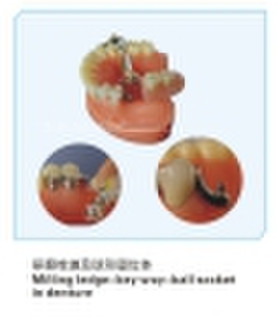 Milling ledge-key way-ball socket in denture