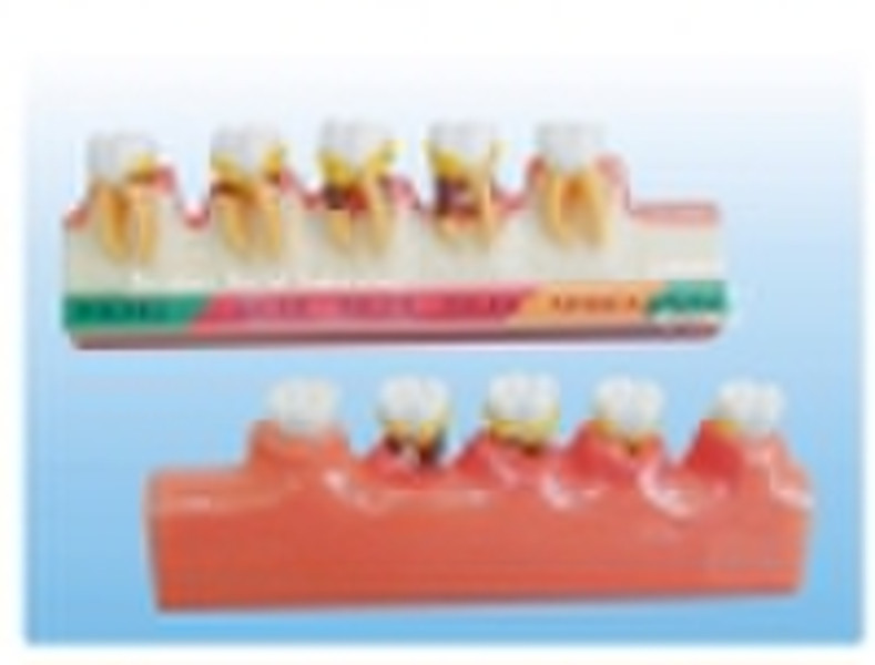 Periodontal classify model