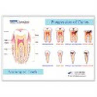 Plastic Chart of Progression of Caries (Small)