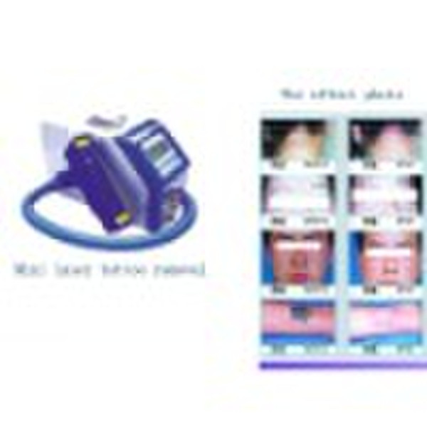 Mini laser tattoo removal machine